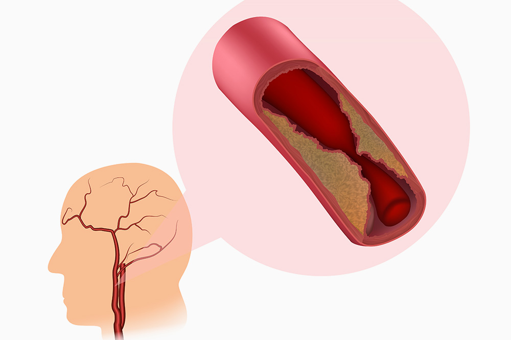 sténose carotidienne